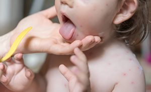 brotoeja em bebes